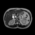 Ampullary tumor (Radiopaedia 27294-27479 T2 13).jpg