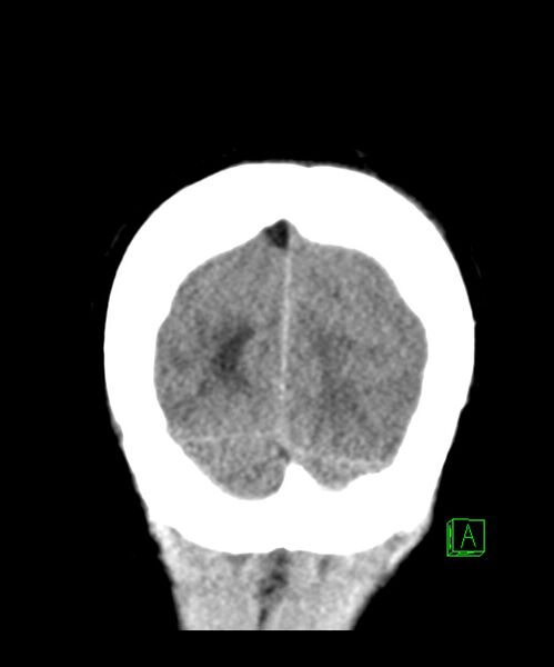 File:Angiomatous meningioma (Radiopaedia 79459-92578 Coronal non-contrast 33).jpg