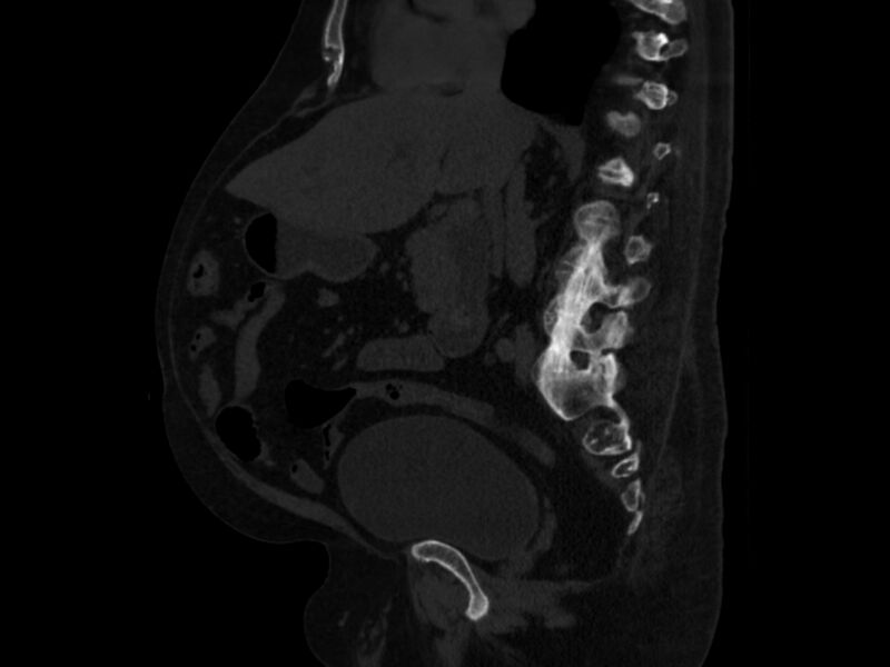 File:Ankylosing spondylitis (Radiopaedia 44609-48357 Sagittal bone window 46).jpg