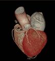 Anomalous left coronary artery- prepulmonic course (Radiopaedia 29253-29667 3D VRT 6).JPG