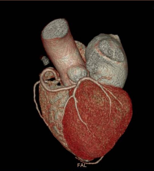 File:Anomalous left coronary artery- prepulmonic course (Radiopaedia 29253-29667 3D VRT 6).JPG