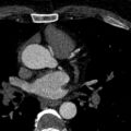 Anomalous origin of the left coronary artery with malignant course (Radiopaedia 77842-90126 C 32).jpeg