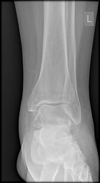 File:Anterior calcaneal process fracture (Radiopaedia 63353-71942 Frontal 1).jpg