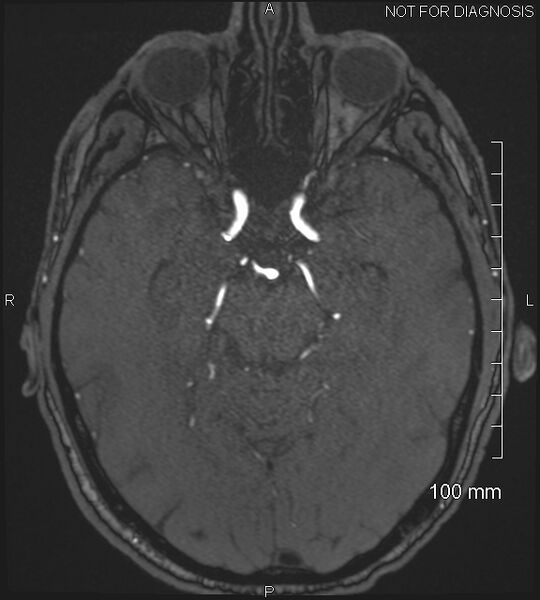 File:Anterior cerebral artery aneurysm (Radiopaedia 80683-94127 Axial MRA 91).jpg