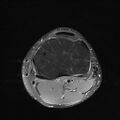 Anterior cruciate ligament full thickness tear (Radiopaedia 66268-75467 Axial PD fat sat 22).jpg