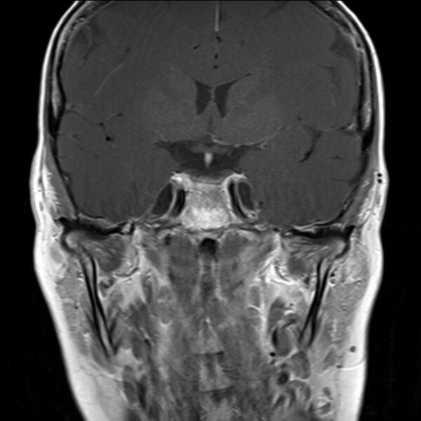 File:Anterior temporal encephalocele (Radiopaedia 82624-96808 Coronal T1 7).jpg
