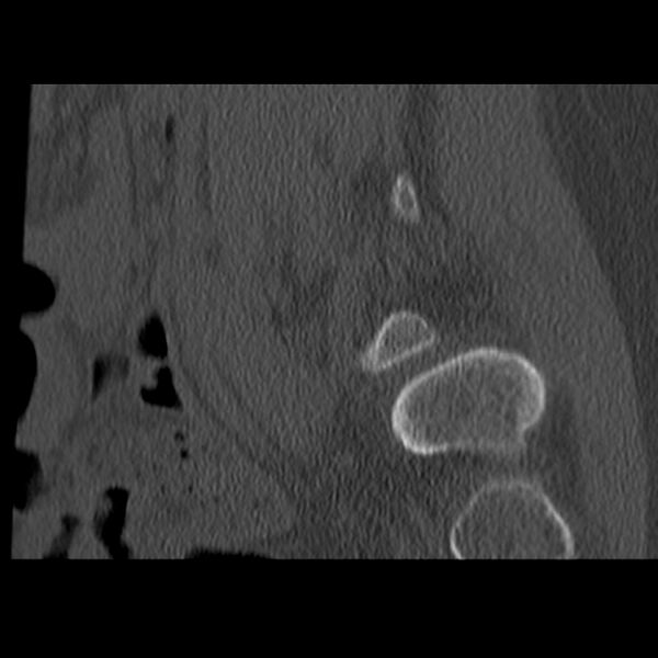 File:Anterolisthesis (Radiopaedia 22226-22263 Sagittal bone window 20).jpg