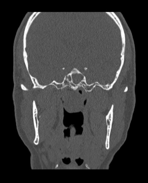 File:Antrochoanal polyp (Radiopaedia 79011-92169 Coronal bone window 15).jpg
