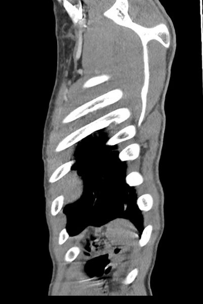 File:Aortic coarctation with aneurysm (Radiopaedia 74818-85828 B 144).jpg