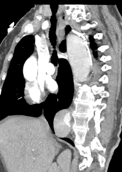 File:Aortic dissection - Stanford type B (Radiopaedia 50171-55512 C 37).png