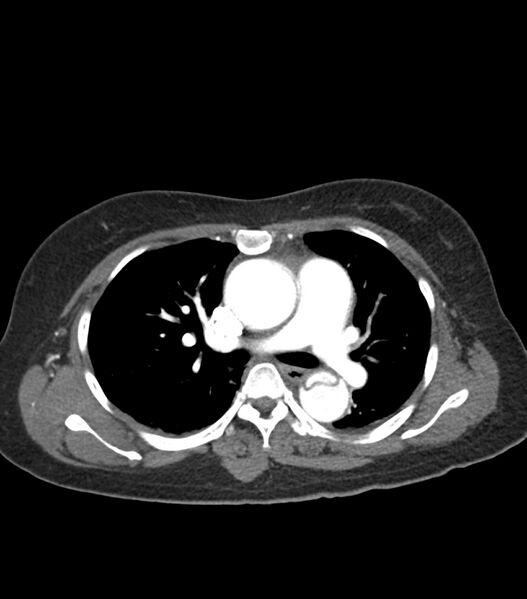 File:Aortic dissection with renal ischemia (Radiopaedia 76573-88338 A 25).jpg
