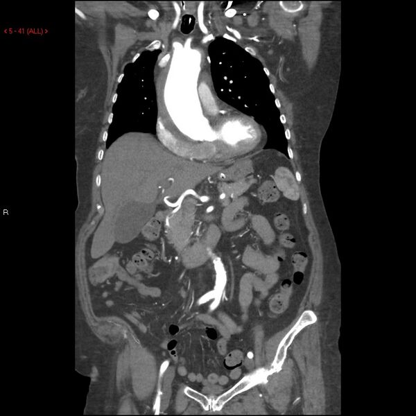 File:Aortic intramural hematoma (Radiopaedia 27746-28001 B 18).jpg