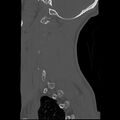 Apical pneumothorax on cervical spine CT (Radiopaedia 45343-49368 Sagittal bone window 1).jpg