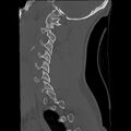Apical pneumothorax on cervical spine CT (Radiopaedia 45343-49368 Sagittal bone window 27).jpg
