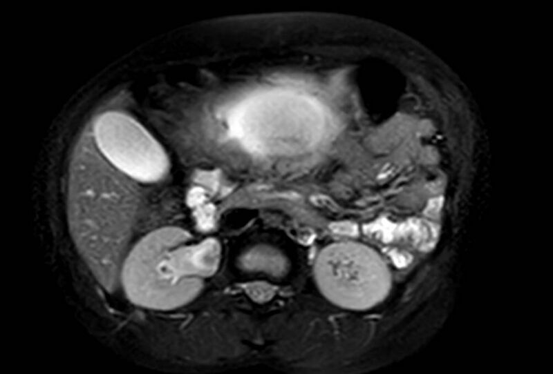 File:Appendicitis in gravida (MRI) (Radiopaedia 89433-106395 Axial T2 SPAIR 30).jpg
