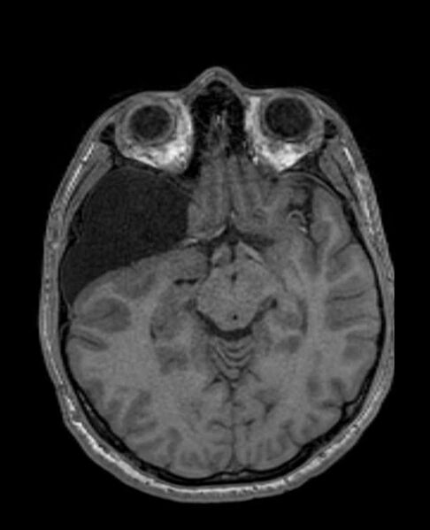 File:Arachnoid cyst- extremely large (Radiopaedia 68741-78451 Axial T1 33).jpg