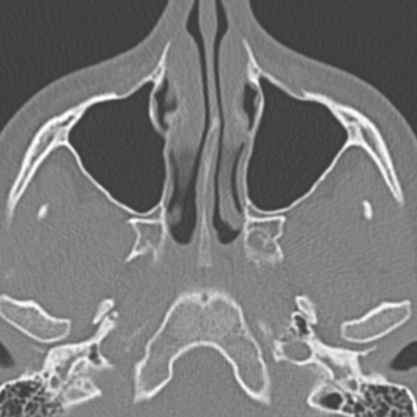 File:Arrested pneumatization of the sphenoid (Radiopaedia 10700-11172 Axial non-contrast 11).jpg