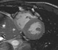 Arrhythmogenic right ventricular cardiomyopathy (Radiopaedia 39806-42237 F 12).jpg