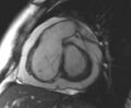 Arrhythmogenic right ventricular cardiomyopathy (Radiopaedia 69431-79307 Short axis cine 171).jpg