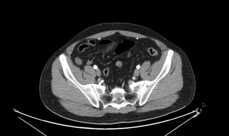 File:Arterial occlusive mesenteric ischemia (Radiopaedia 84641-100060 A 104).jpg
