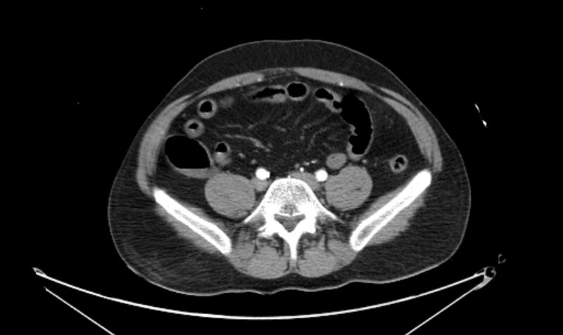 File:Arterial occlusive mesenteric ischemia (Radiopaedia 84641-100060 A 91).jpg