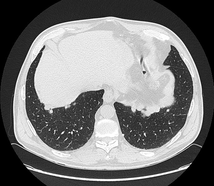 File:Asbestos pleural placques (Radiopaedia 57905-64872 Axial lung window 196).jpg