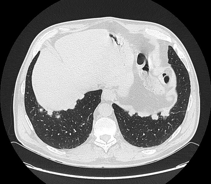 File:Asbestos pleural placques (Radiopaedia 57905-64872 Axial lung window 200).jpg
