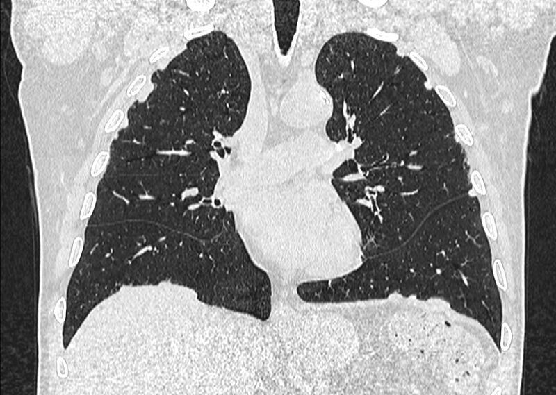 File:Asbestos pleural placques (Radiopaedia 57905-64872 Coronal lung window 134).jpg