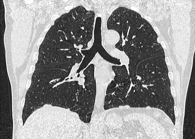 File:Asbestos pleural placques (Radiopaedia 57905-64872 Coronal lung window 162).jpg