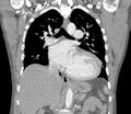 Ascending aortic aneurysm (Radiopaedia 86279-102297 B 36).jpg
