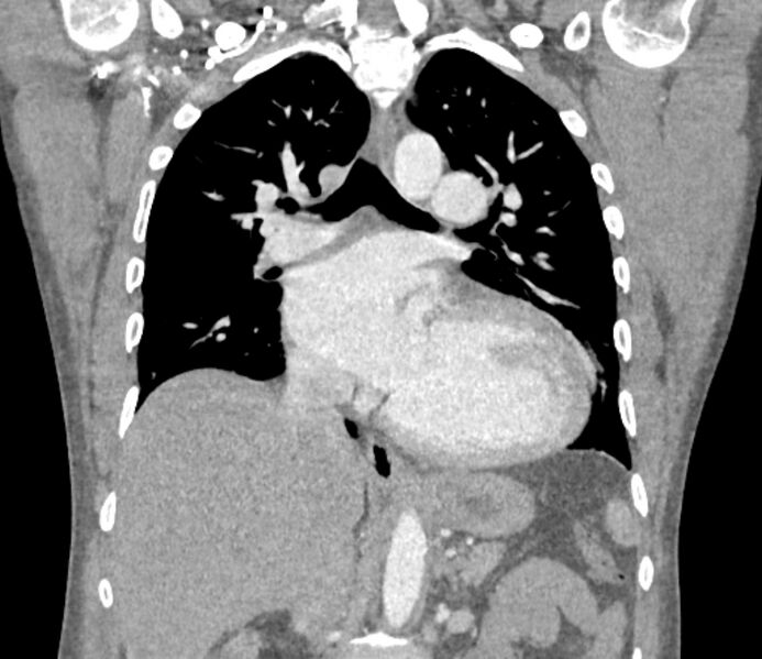 File:Ascending aortic aneurysm (Radiopaedia 86279-102297 B 36).jpg