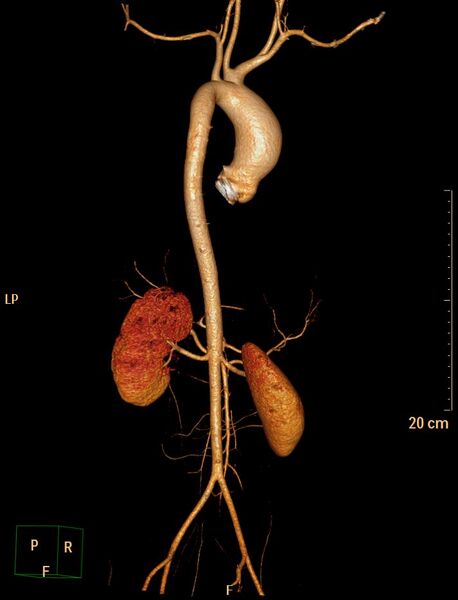File:Ascending aortic pseudoaneurysm (Radiopaedia 28638-28910 D 14).jpg