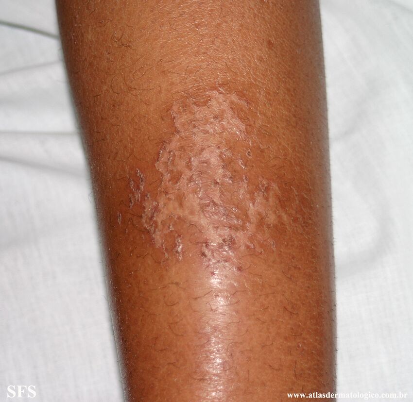 Asteatotic Dermatitis (Dermatology Atlas 12).jpg