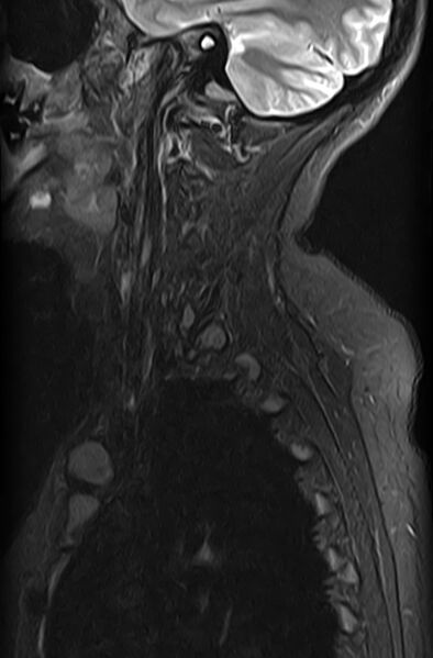 File:Astrocytoma - spinal cord (Radiopaedia 69769-79758 Sagittal STIR 1).jpg