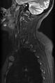 Astrocytoma - spinal cord (Radiopaedia 69769-79758 Sagittal STIR 1).jpg