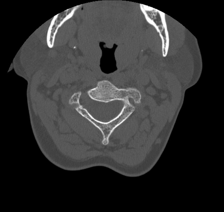 Atlanto-occipital assimilation with basilar invagination (Radiopaedia 70122-80188 Axial bone window 43).jpg