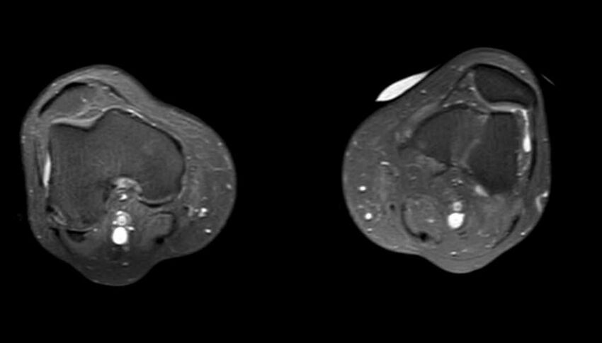 Atypical lipomatous tumor - thigh (Radiopaedia 68975-78734 Axial PD fat sat 12).jpg