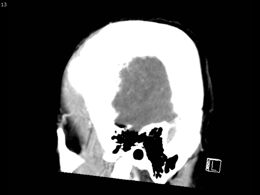 Atypical meningioma - intraosseous (Radiopaedia 64915-73867 F 12).jpg