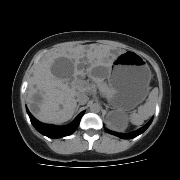 File:Autosomal dominant polycystic kidney disease (Radiopaedia 23061-23093 Axial non-contrast 16).jpg