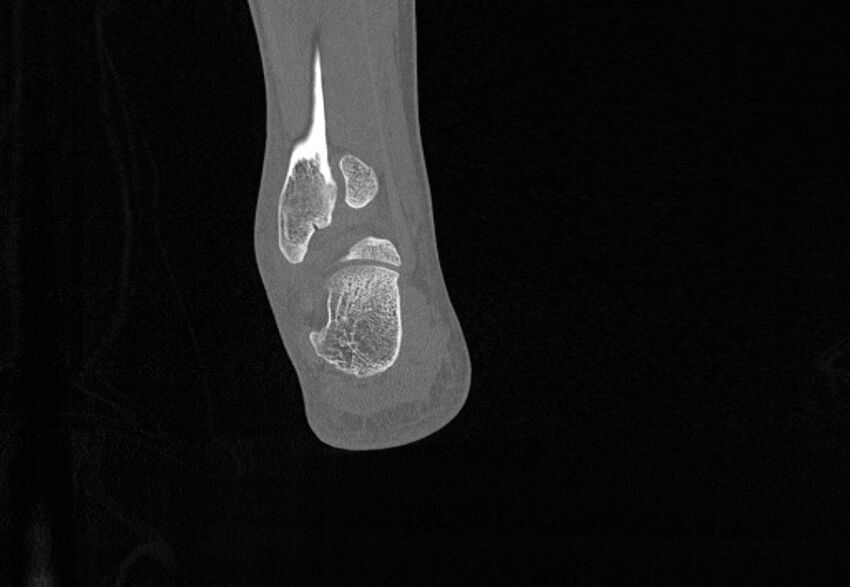 Avulsion fractures of talus and calcaneus (Radiopaedia 48277-53155 Coronal bone window 83).jpg