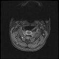 Axis fracture - MRI (Radiopaedia 71925-82375 Axial T2 fat sat 1).jpg