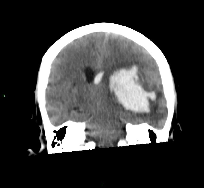 Basal ganglia hemorrhage (Radiopaedia 58759-65981 Coronal non-contrast 36).jpg