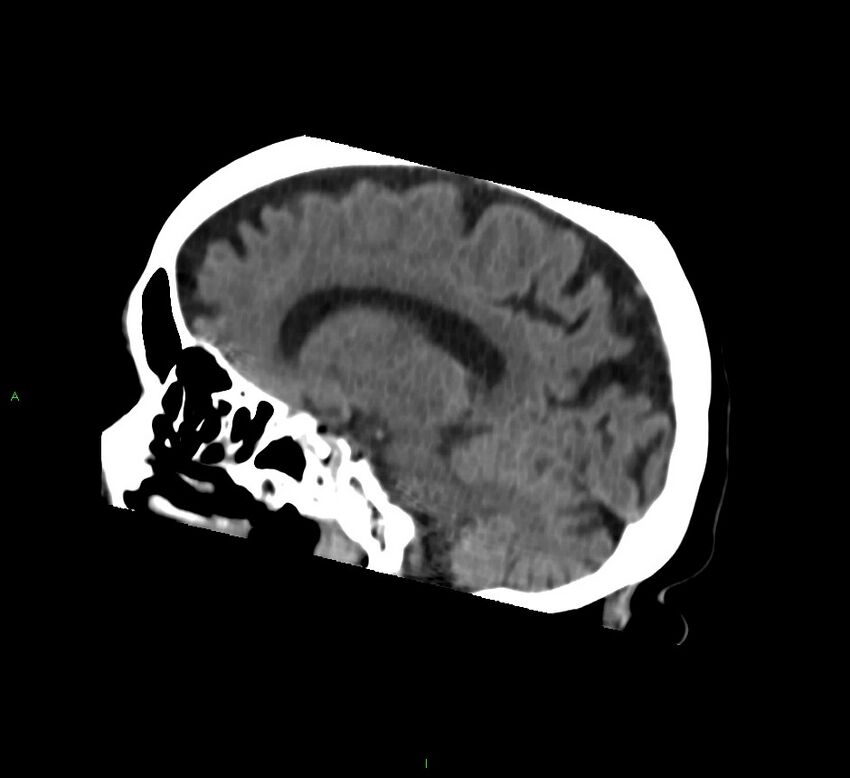 Basal ganglia hemorrhage (Radiopaedia 58762-65984 B 23).jpg