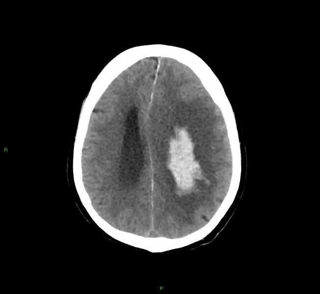 File:Basal ganglia hemorrhage (Radiopaedia 58775-66008 Axial non-contrast 23).jpg