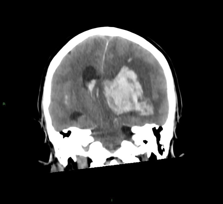 Basal ganglia hemorrhage (Radiopaedia 58775-66008 Coronal non-contrast 32).jpg