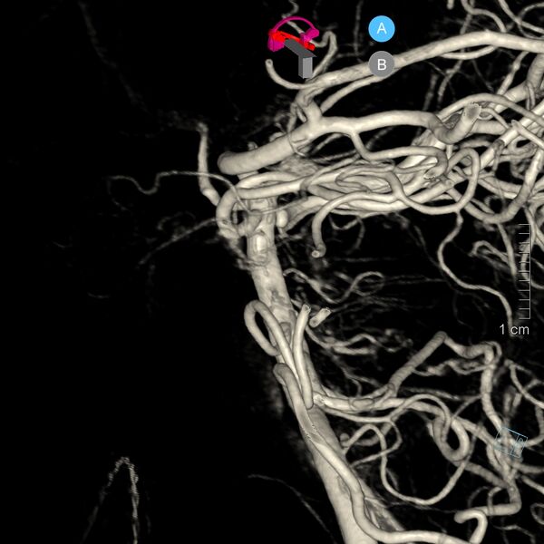 File:Basilar artery perforator aneurysm (Radiopaedia 82455-97734 3D view left VA 14).jpg