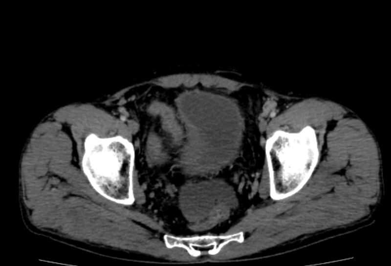 File:Behçet's disease- abdominal vasculitis (Radiopaedia 55955-62570 A 82).jpg