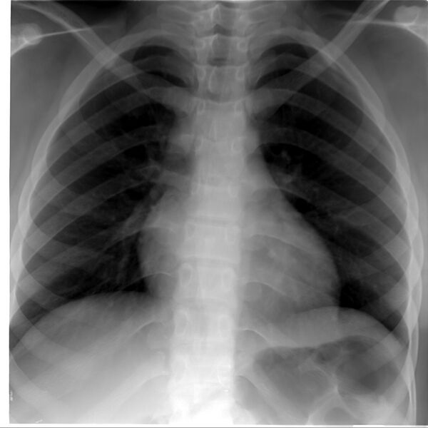 File:Benign esophageal stricture (Radiopaedia 23008).jpg
