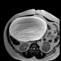 Benign seromucinous cystadenoma of the ovary (Radiopaedia 71065-81300 B 28).jpg