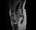 Bicornuate bicollis uterus (Radiopaedia 61626-69616 Sagittal T2 28).jpg